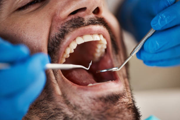 Best Emergency Dentist for Lost Fillings or Crowns in Redmond, WA